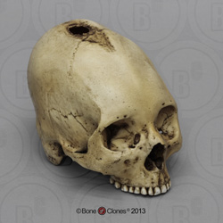 Human Trephined Skull BC-115