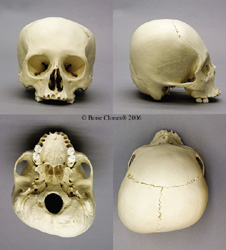 Human Adult Cradle-boarded Skull BC-222