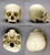 Human Adult Cradle-boarded Skull