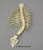 Human Child Vertebra, Ribs and Sacrum Scoliosis