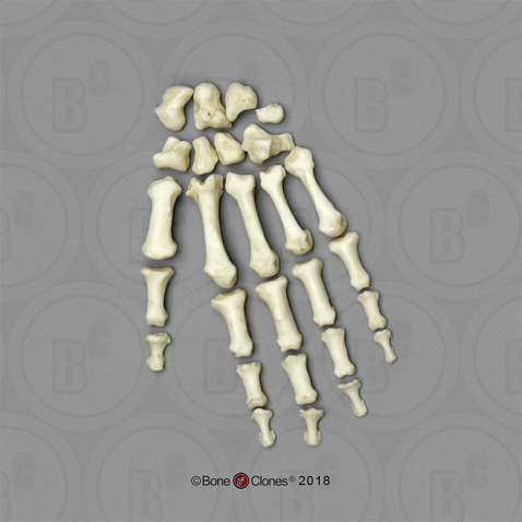 Human Female Achondroplasia Dwarf Hand, Disarticulated