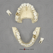 Human Female Teeth, Removable on Partial Mandible and Maxilla