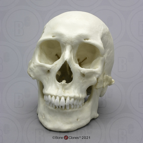 Human Healed Trauma Skull