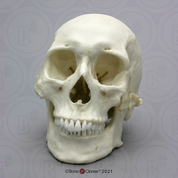 Human Healed Trauma Skull