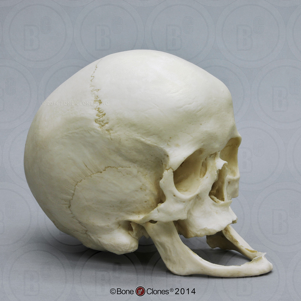 Human Female Achondroplasia Dwarf Skull - Bone Clones, Inc