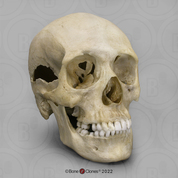 Adult Female Human Skull with small-caliber Gunshot Wounds