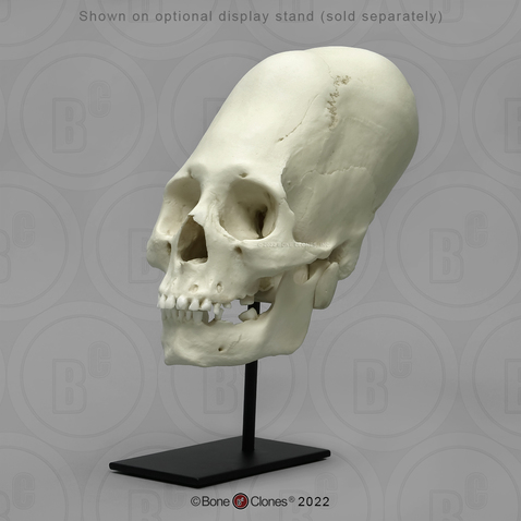 Human Peruvian Female Skull with Cranial Binding