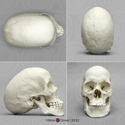 Human Female Scaphocephalic Skull