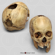 Adult Female Human Skull .410 Shotgun Wounds