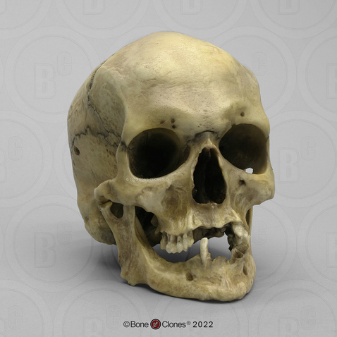 Adult Human Female Masculinized Skull