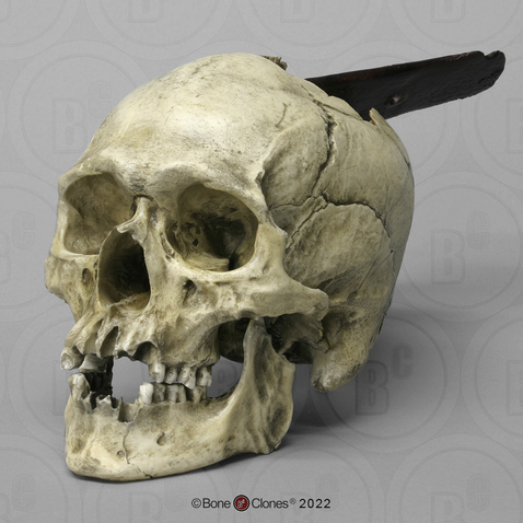 Spanish Conquistador Human Skull with Broad Ax Trauma - Bone