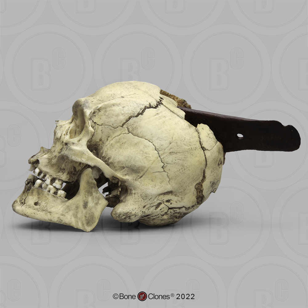 Spanish Conquistador Human Skull with Broad Ax Trauma - Bone