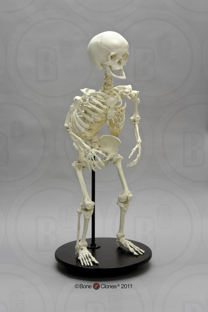 Human Female Achondroplasia Dwarf Skeleton, Articulated - Bone Clones