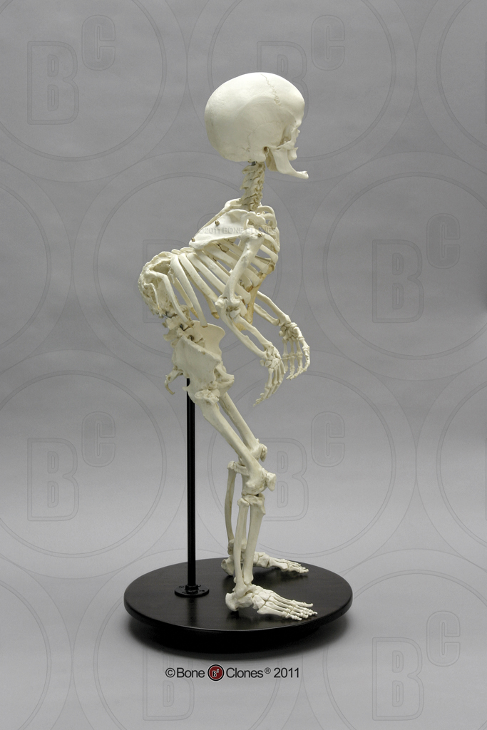 Human Female Achondroplasia Dwarf Skeleton, Articulated - Bone Clones