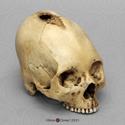 Human Trephined Skull