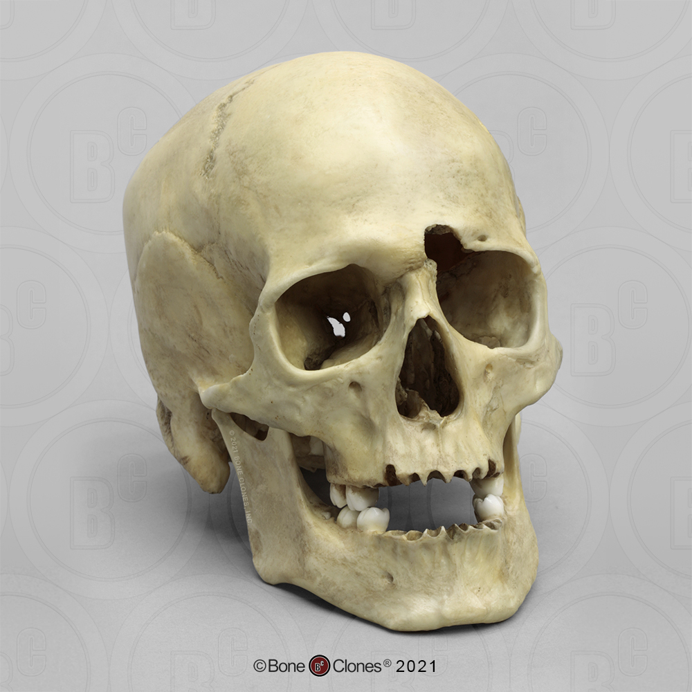 Human Male Skull with a 32-caliber Gunshot Wound - Bone Clones ...
