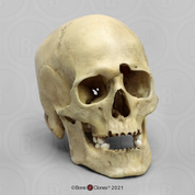 Human Male Skull with a 32-caliber Gunshot Wound