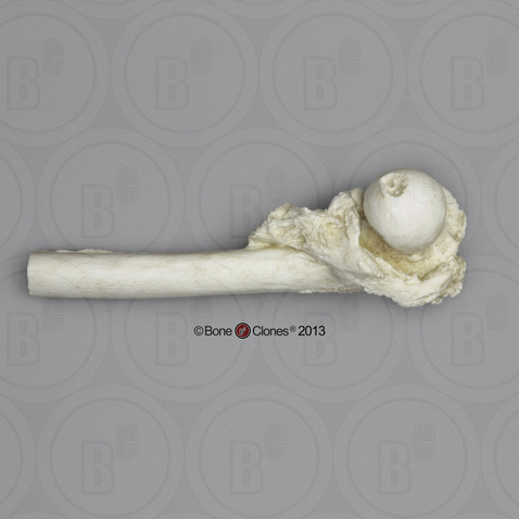 Human Partial Left Femur with Healed Hip Fracture