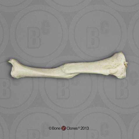 Human Left Tibia with Healed Fracture