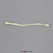 Human Left Fibula with Healed Fractures