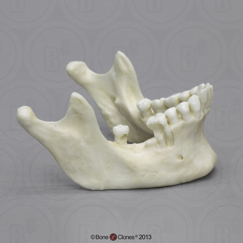 Human Male Mandible with Dental Abscessing