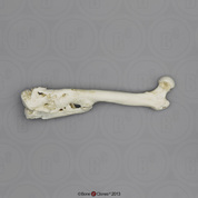 Human Left Femur with Healed Comminuted Fracture