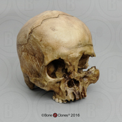 Human Male Cranium with Mid-facial Blunt Force Trauma