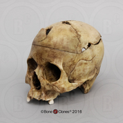 Human Male Cranium with Sharp Force Trauma