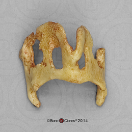 Human 68-year-old Male Ossified Thyroid