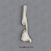 Human Right Tibia with Femur Bone Graft