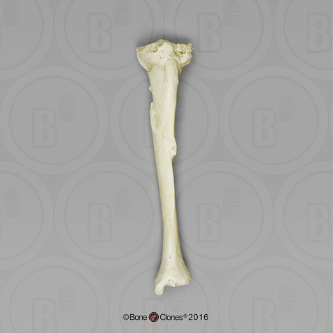 Healed Left Tibia Fracture