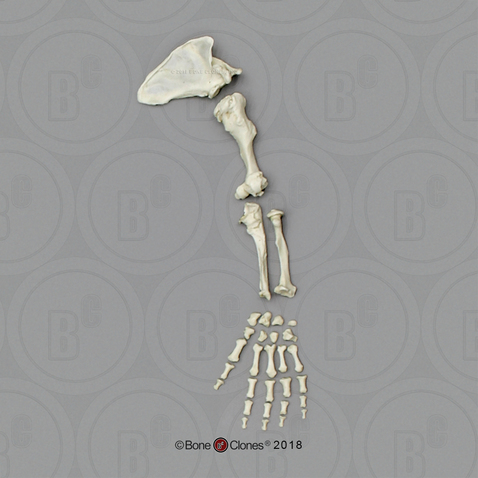 Human Female Achondroplasia Dwarf Arm, Disarticulated with Scapula