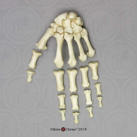 Human Female Achondroplasia Dwarf Hand, Semi-articulated