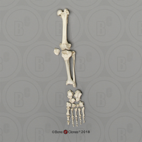 Human Female Achondroplasia Dwarf Leg, Disarticulated