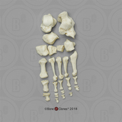 Human Female Achondroplasia Dwarf Foot, Disarticulated