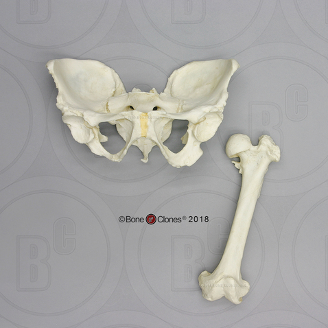 Human Female Achondroplasia Dwarf Pelvis and Femur Set