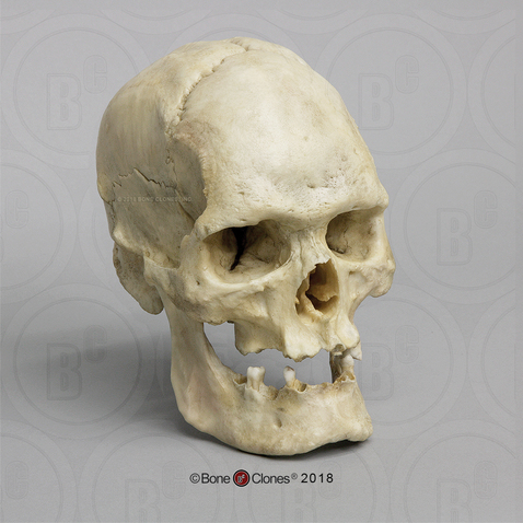 Human Male Acromegaly Skull