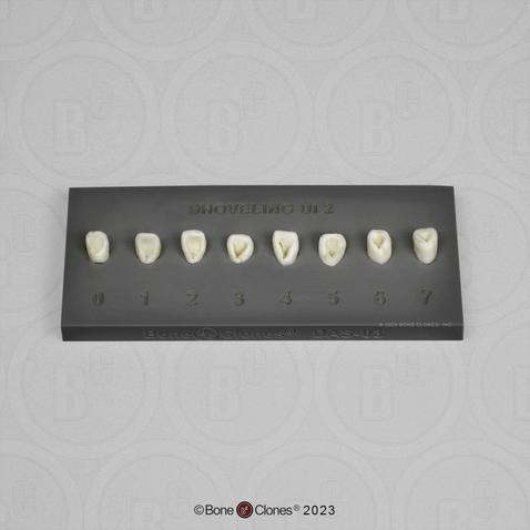 The Turner-Scott Dental Anthropology System - Shoveling Upper Incisor 2 Dental Plaque