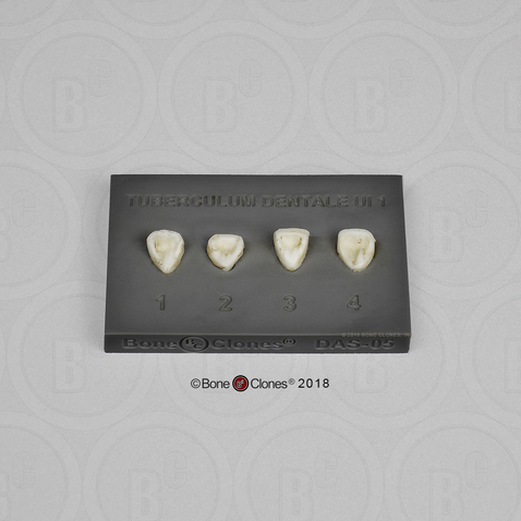 The Turner-Scott Dental Anthropology System - Tuberculum Dentale Upper Incisor 1 Dental Plaque