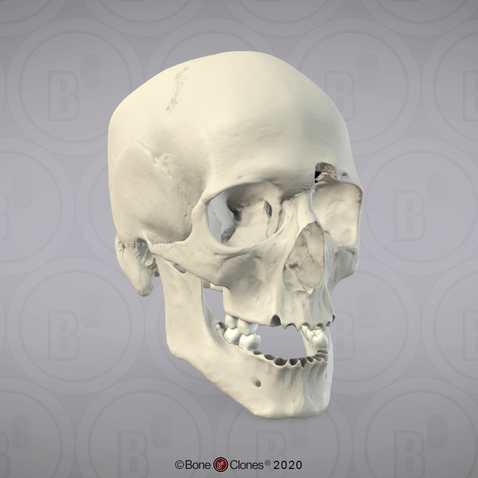 3D OsteoViewer - Human Skull, Medium Caliber Gunshot Wound, Male