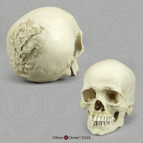 Human Skull, Syphilis