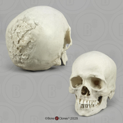 Human Skull, Syphilis
