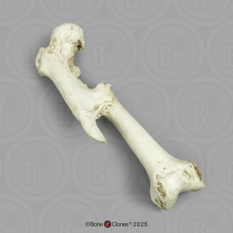 Human Right Femur Fracture with Malunion