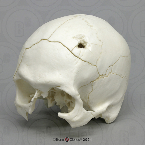 Human Male Cranium Classic Entry-Exit Gunshot Wounds