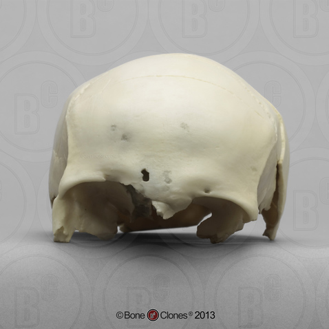 Human Female Partial Skull with Shotgun Pellets Embedded