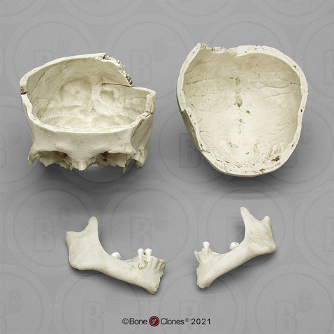 Human Native American Female Skull exhibiting Trauma and Hyperostosis frontalis