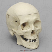 Human Male Skull, 22 Caliber Bullet Wound with Calvarium Cut