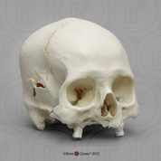 Human Male Skull, Leishmaniasis