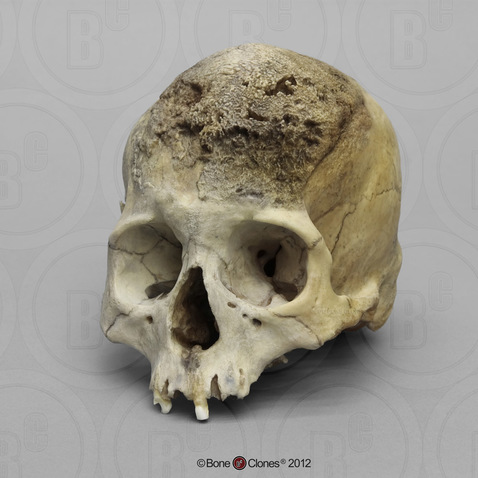 Human Female Cranium, Meningioma