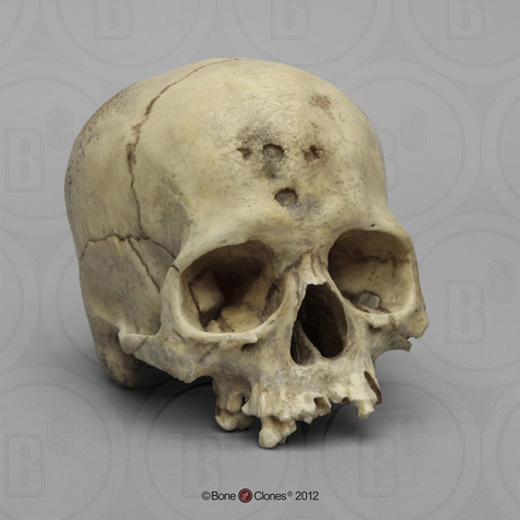 Photo Human Skull Of Syphilis Victim 1910s. 